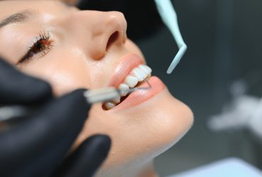 Lamine Diş Kaplama Nedir? Avantajları, Uygulama Süreci ve Sık Sorulan Sorular