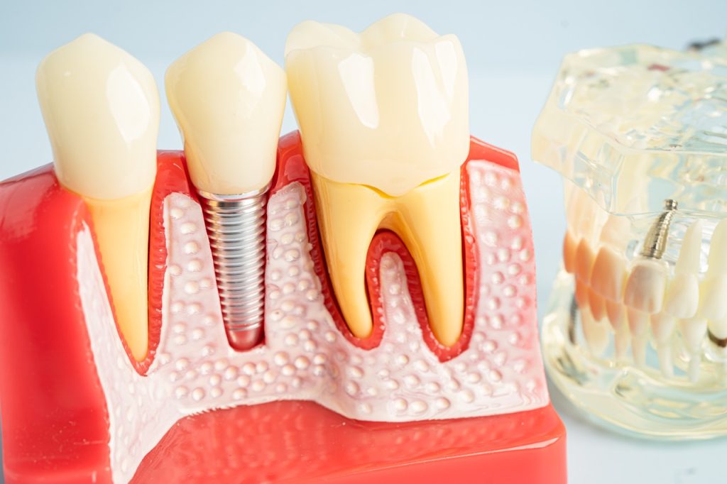 implant