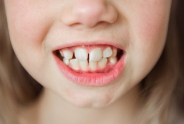 Okula Başlarken Çocuklarda Diş Sağlığı